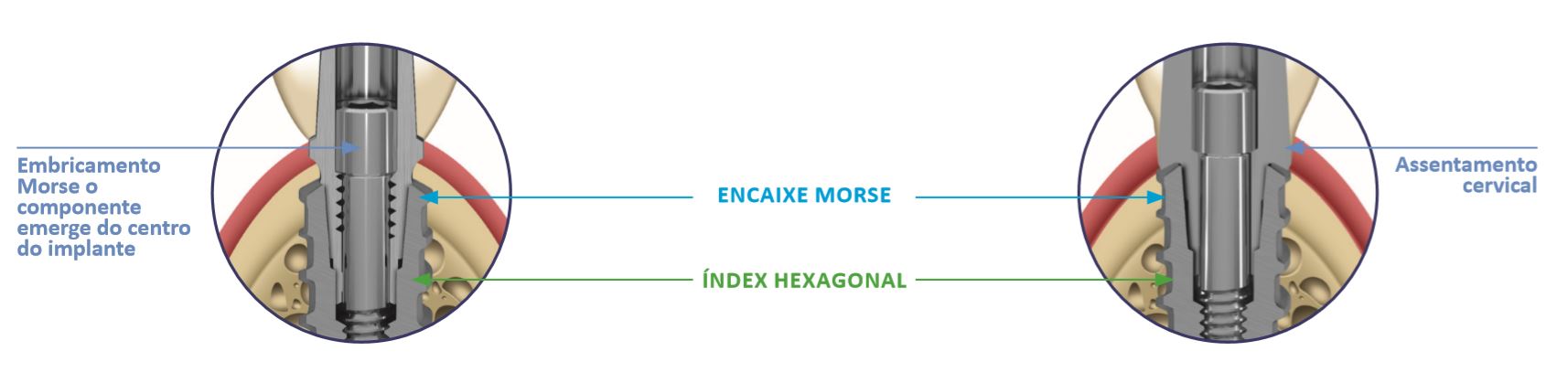 Soluções protéticas Implante Cone Morse | Linha Zero