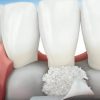 Conheça os tipos de enxerto ósseo para implante dentário