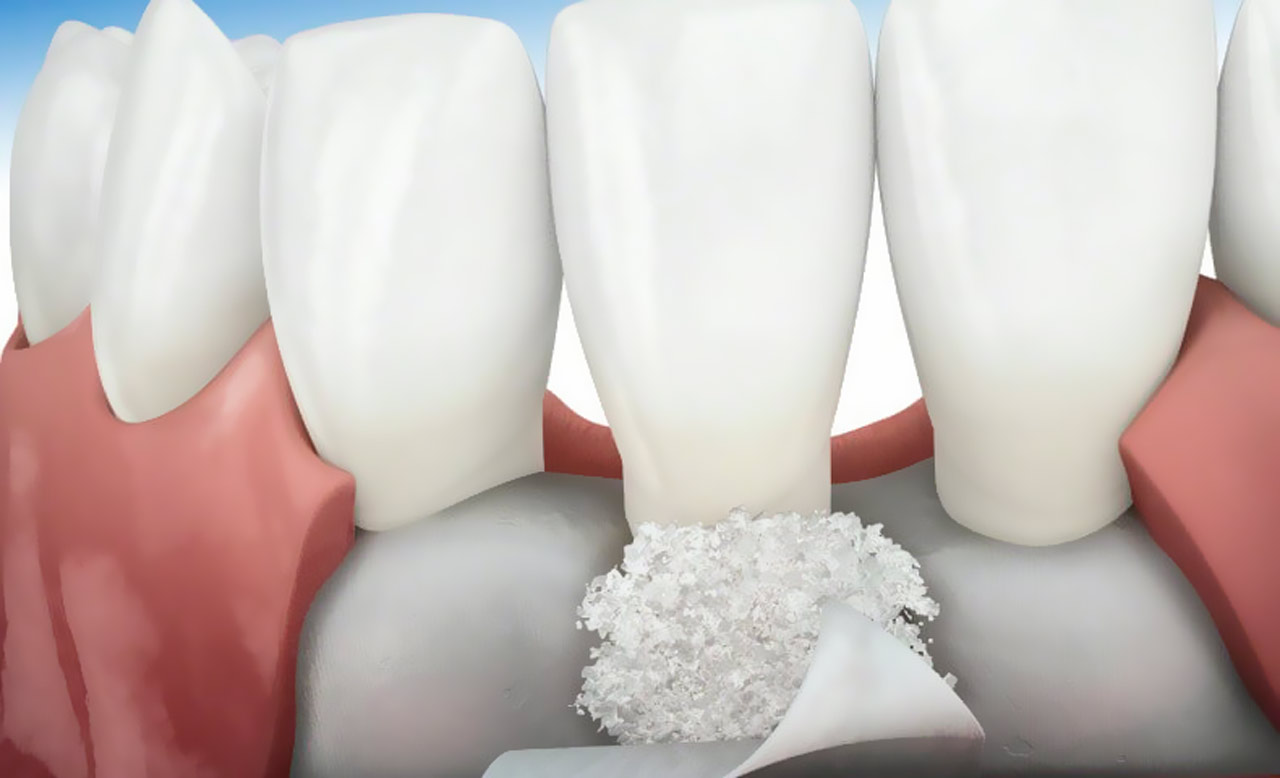 Conheça os tipos de enxerto ósseo para implante dentário