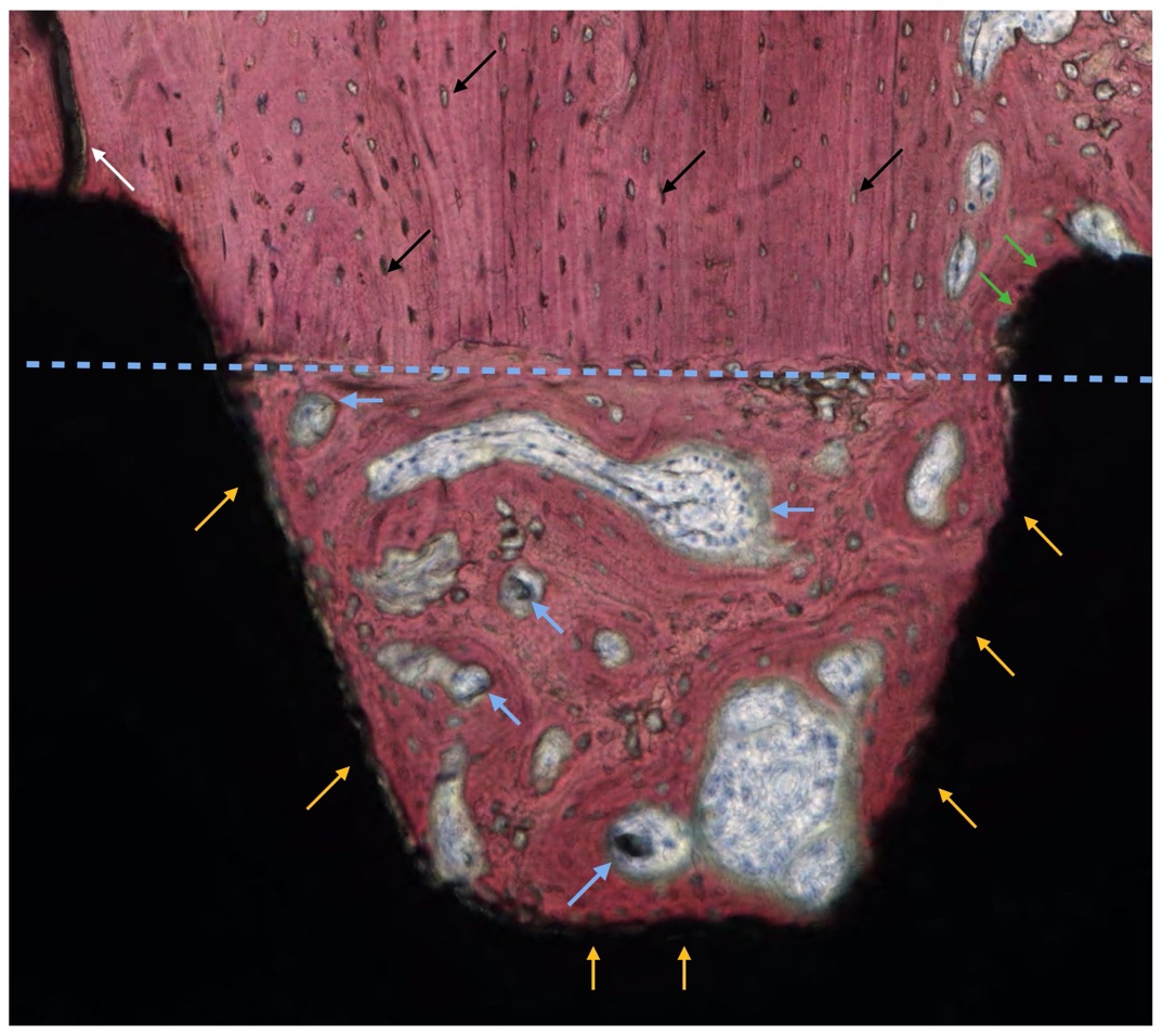 a importância do desenho de câmaras de osseointegração na macrogeometria do implante