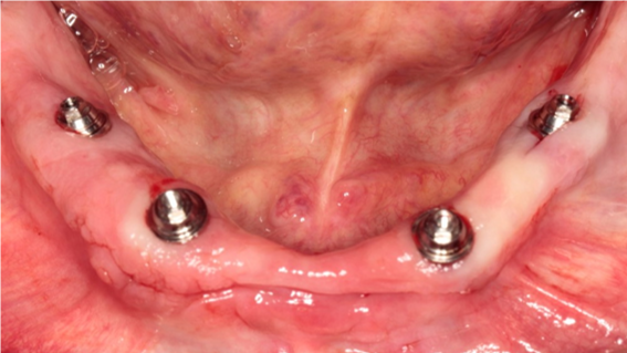 Pós operatório imediato de cirurgia para instalação de 4 implantes em mandibula no conceito cirurgia flapless.