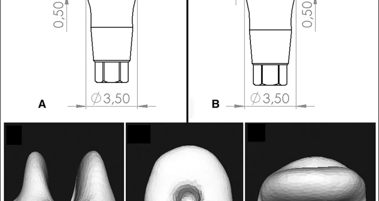 Efeito da altura do pilar CAD/CAM e do tipo de cimento na retenção de coroas de zircônia