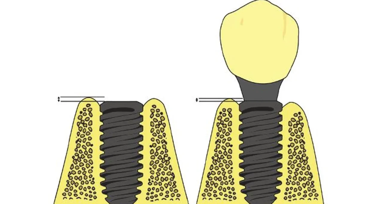 Avaliação clínica baseada na prática de implantes dentários colocados com protocolos de carga imediata ou retardada: acompanhamento de um ano