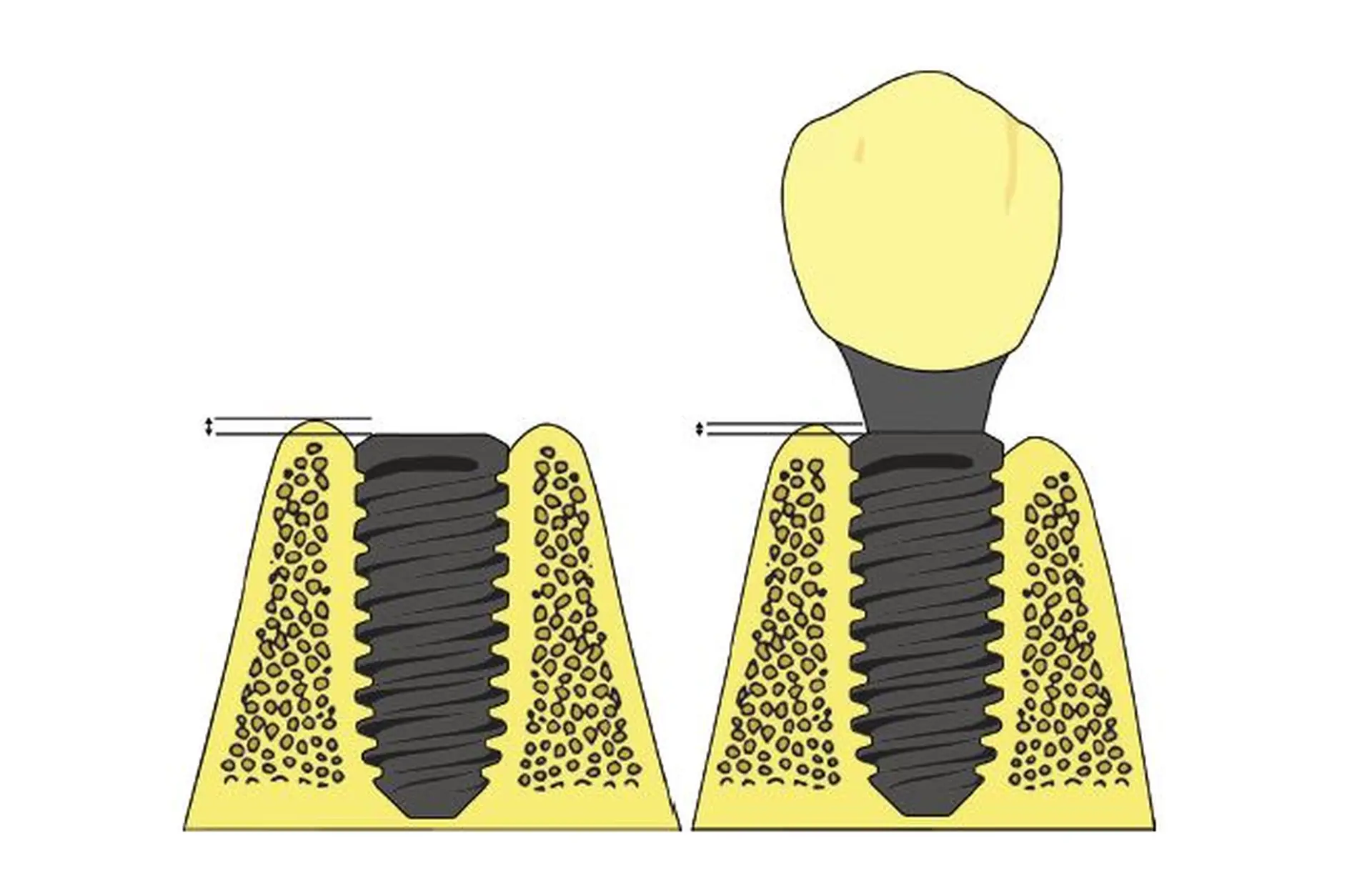 Avaliação clínica baseada na prática de implantes dentários colocados com protocolos de carga imediata ou retardada: acompanhamento de um ano