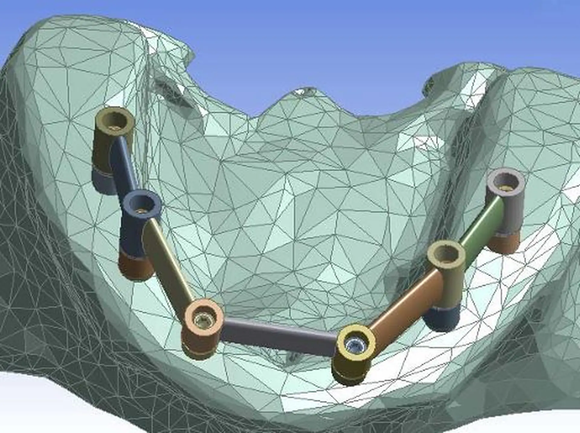 Análise das Tensões em Implantes Hexágono Externo e Cone Morse, Sistemas com 6 e 4 Implantes