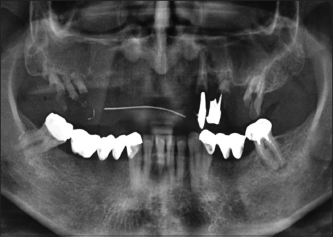 Artigo | Long-term Retrospective Study of Implants Placed after Sinus Floor Augmentation with Fresh-frozen homologous block