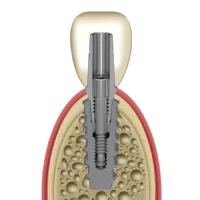Os componentes protéticos para solução cone morse são utilizados quanto o implante cone morse é instalado 1mm infra-ósseo.