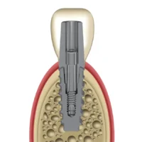 Os componentes protéticos para solução linha zero são utilizados quanto o implante cone morse é instalado no nível ósseo.